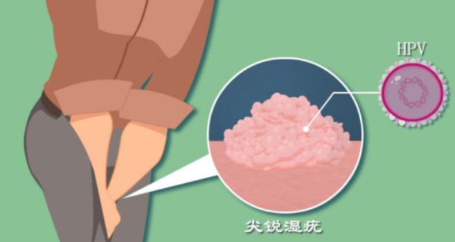 HPV凝膠貼牌廠家
